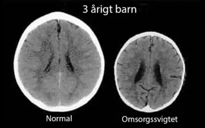 Brain function of children in care