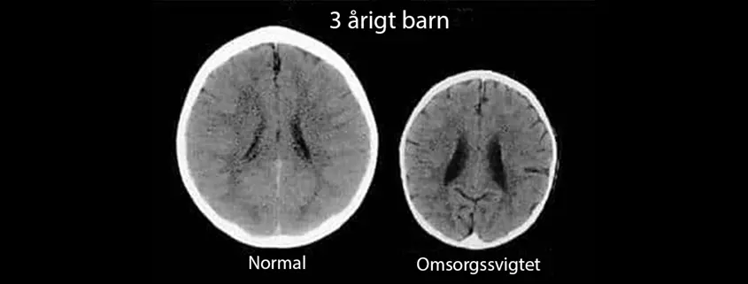 Brain function of children in care